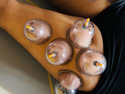 Cupping Therapy
